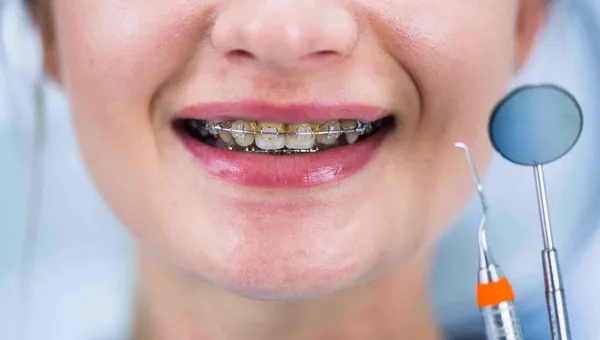 Zbliżenie na uśmiech z aparatem stałym i narzędziami dentystycznymi obok