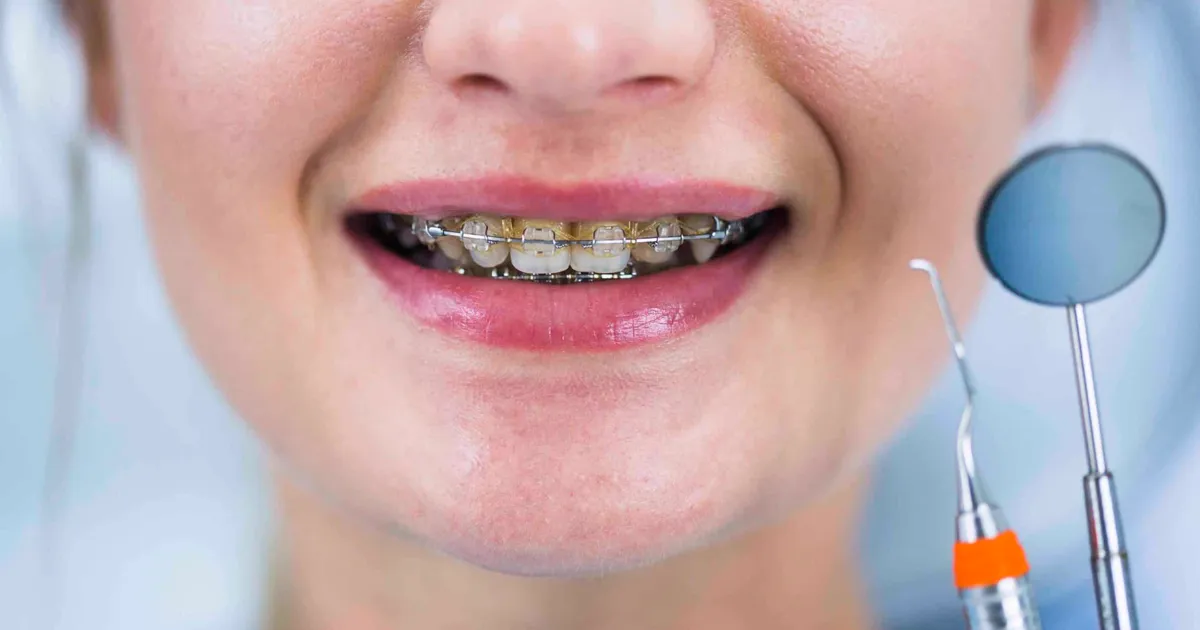 Zbliżenie na uśmiech z aparatem stałym i narzędziami dentystycznymi obok
