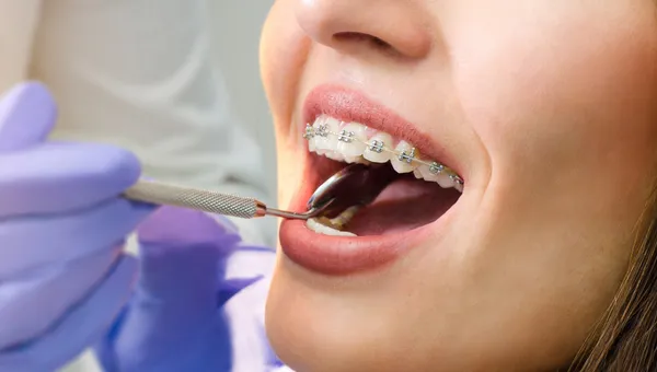 Zbliżenie na aparat stały podczas kontroli narzędziem dentystycznym