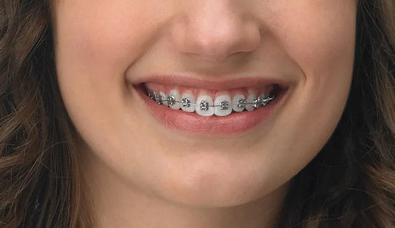 Zamki metalowe przyklejone do zębów, spięte łukiem ortodontycznym