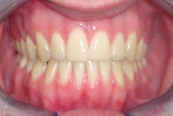 Wynik leczenia ortodontycznego proste zęby