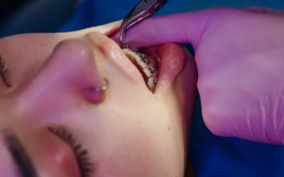 Aparat ruchomy czy stały? Dostępne metody leczenia ortodontycznego.