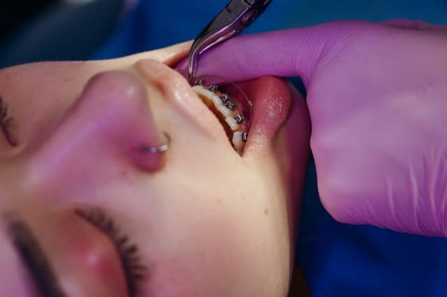 Aparat ruchomy czy stały? Dostępne metody leczenia ortodontycznego.