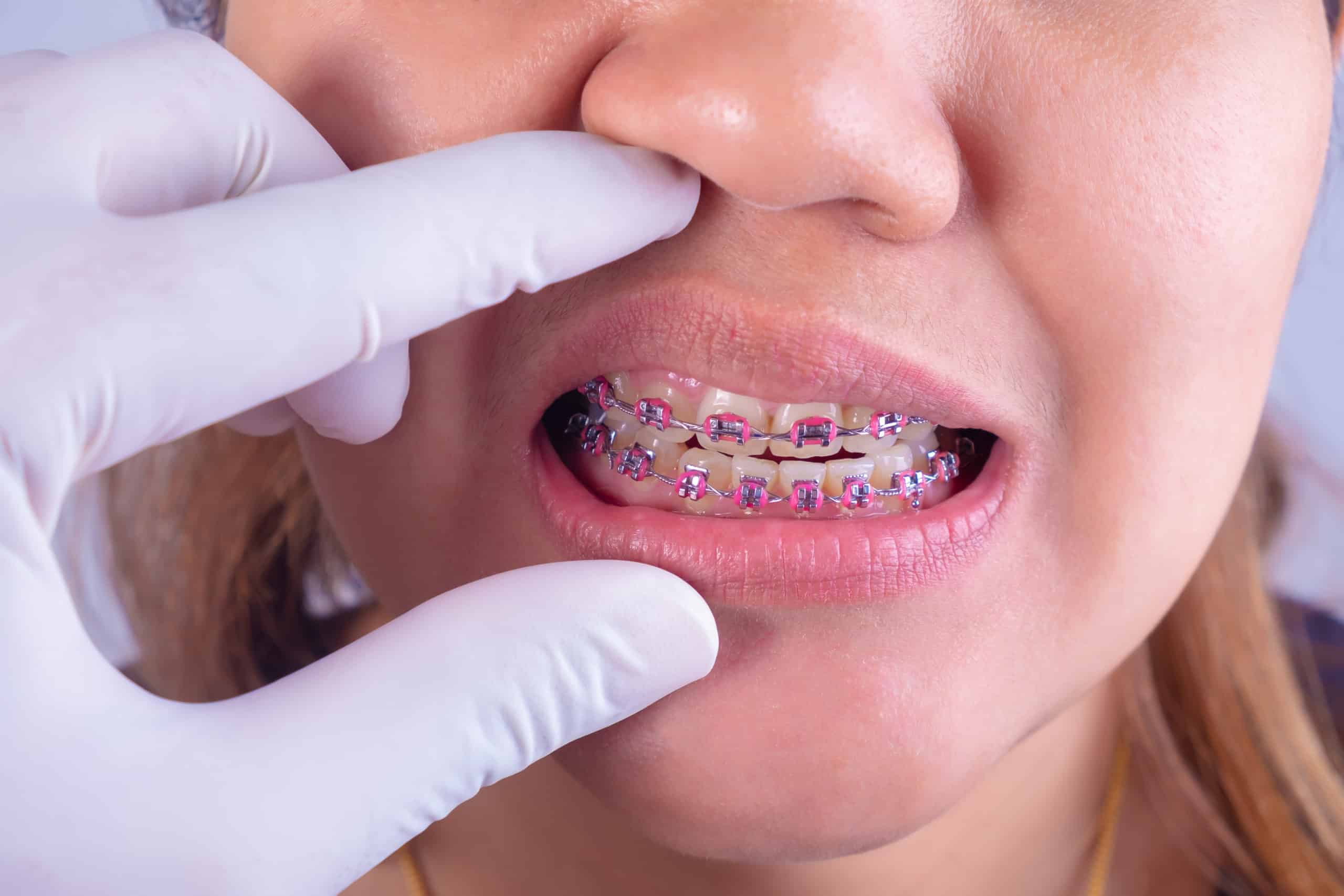 Wyciągi ortodontyczne – po co się je stosuje?