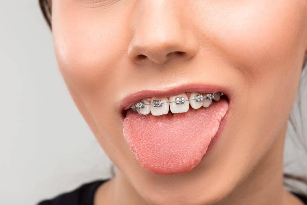 Usuwanie zębów w trakcie leczenia ortodontycznego – czy jest potrzebne