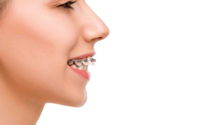 Krzywe zęby – leczenie i przyczyny