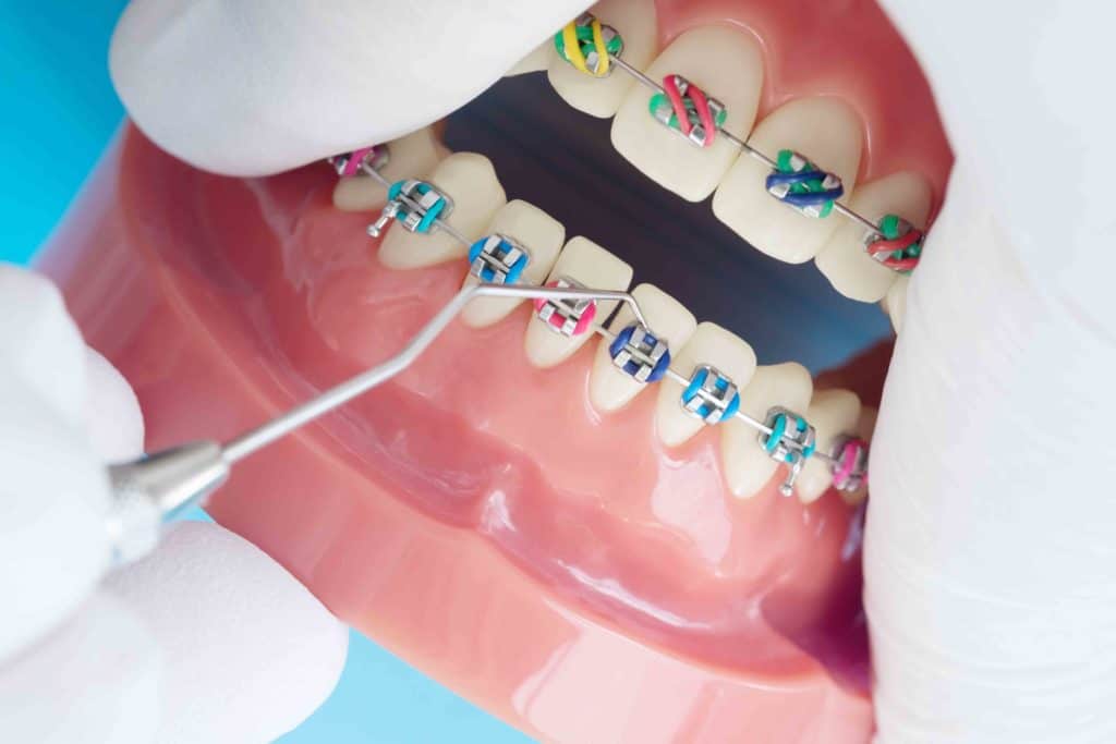 Aparat ortodontyczny – gumki