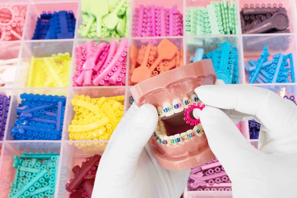 Aparat ortodontyczny – gumki kolory