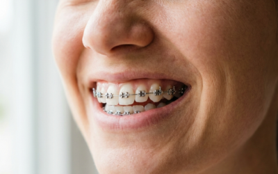 Jak działa aparat na zęby(aparat ortodontyczny)?